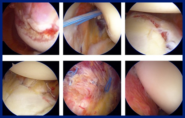 최소 절개 수술